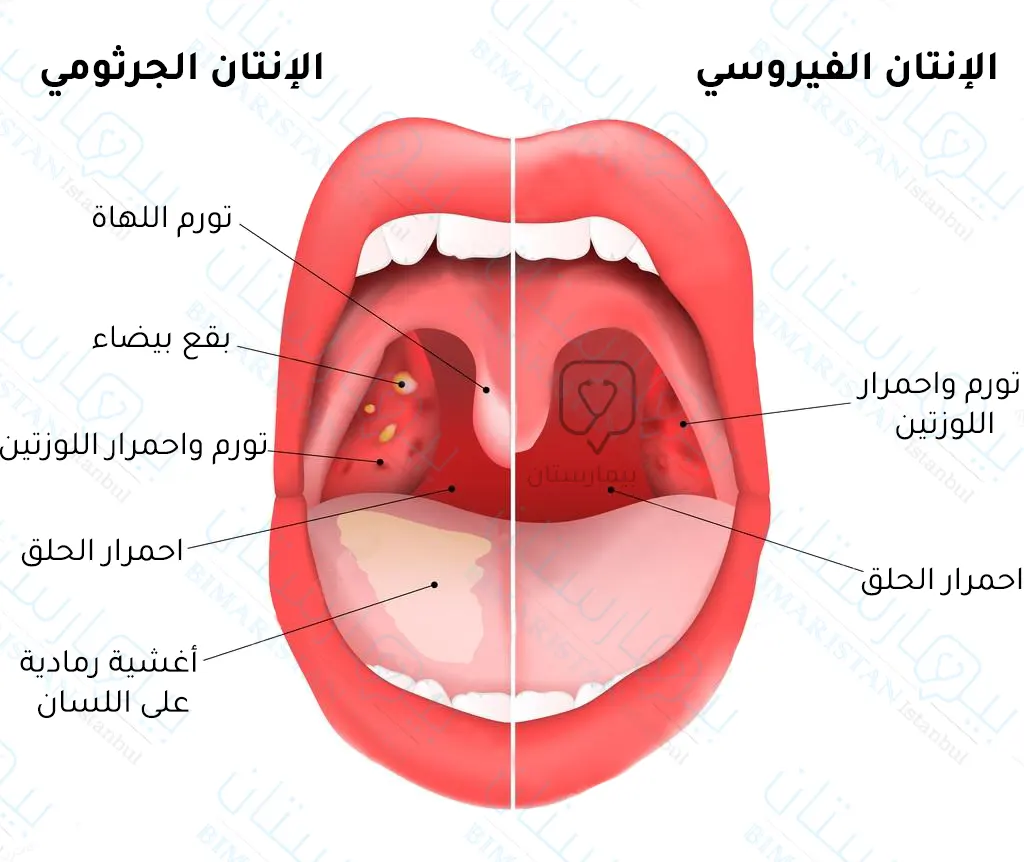 تحليل الاستخدامات: لا يمكن استعمال الحناء في الغرغرة لالتهاب اللوزتين